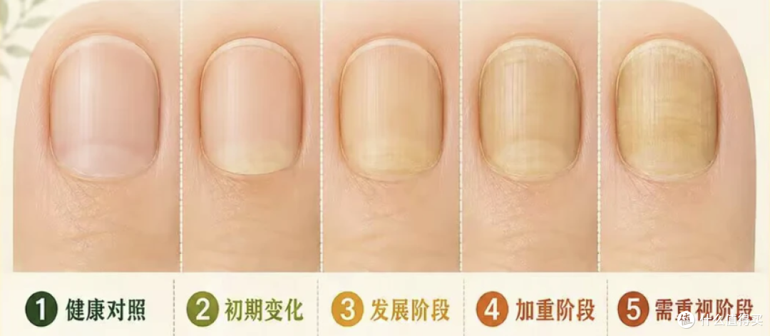手上没有月牙,就是体虚?别被指甲传言骗了