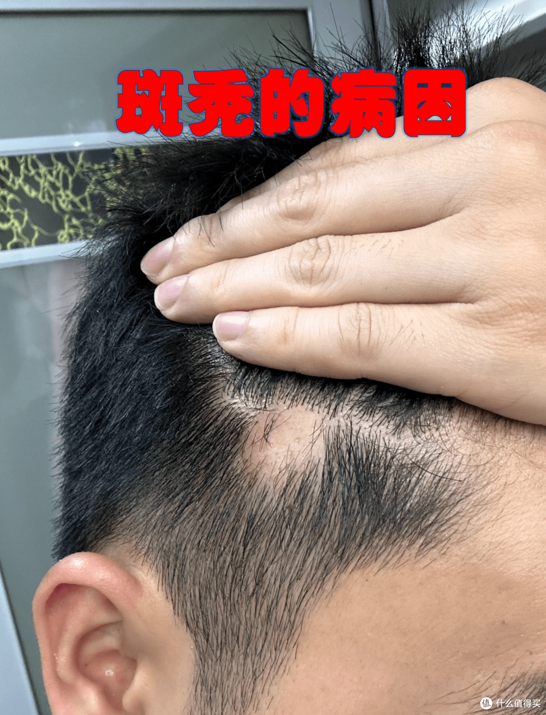 熬夜高压后头皮秃一块?斑秃专挑年轻人下手,乱涂生姜反而耽误治