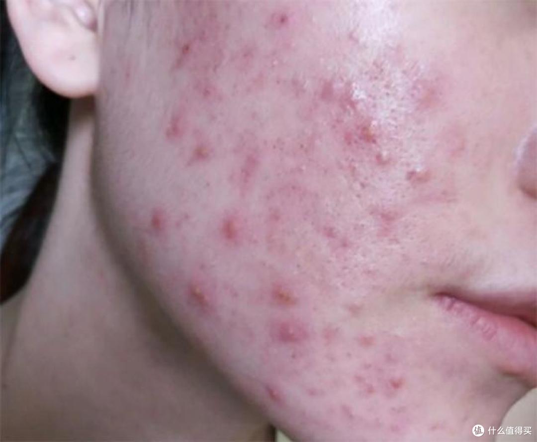 一颗痘痘的形成要八周?