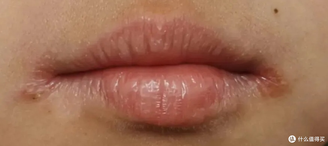 撕嘴皮上瘾，就算流血了还是一直撕，其实是身体疾病在暗示