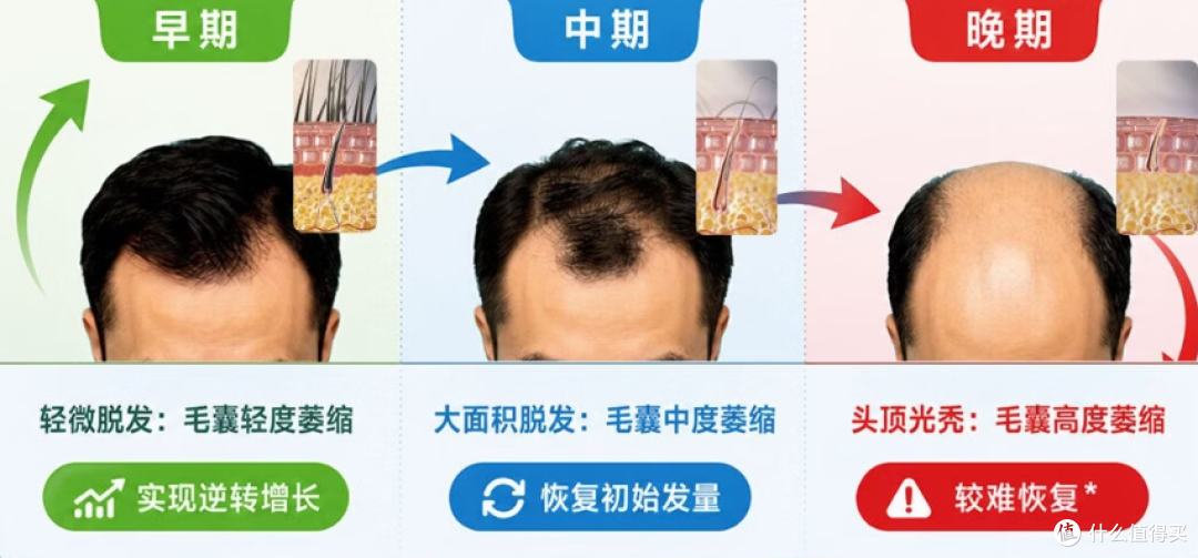 男生脱发一定要用米诺吗?4招教你少走弯路