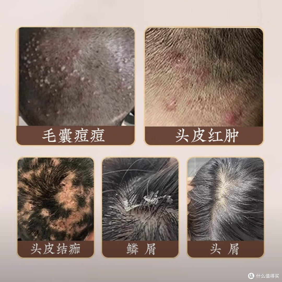 头屑、结痂、长痘折腾我N年:最后被一瓶中药洗发水捞上岸!