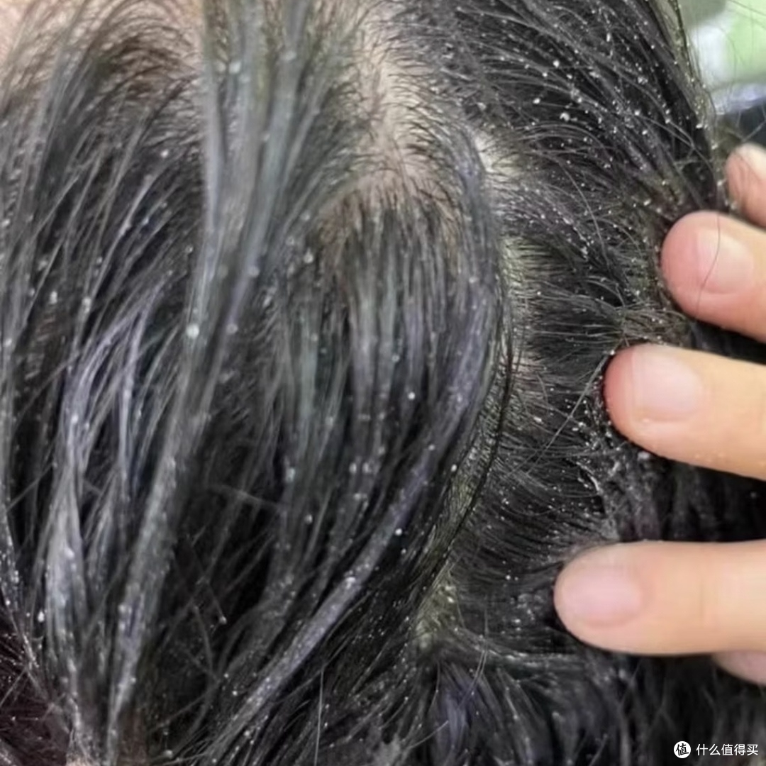 头屑、结痂、长痘折腾我N年:最后被一瓶中药洗发水捞上岸!