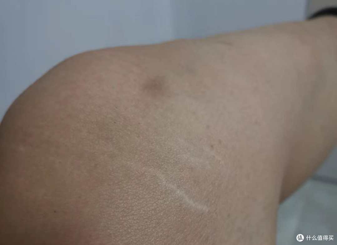 膝盖生长纹