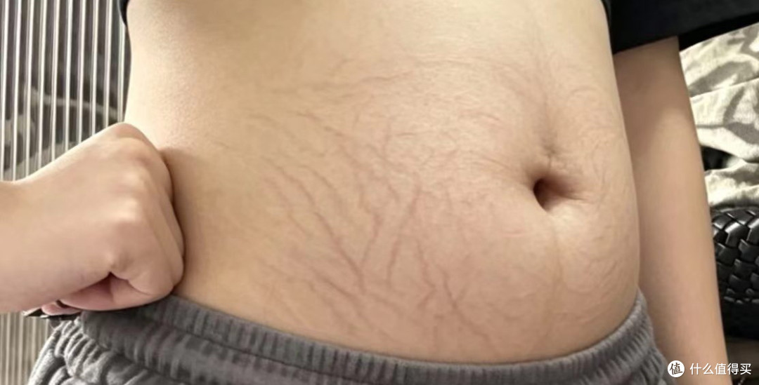 妊娠纹