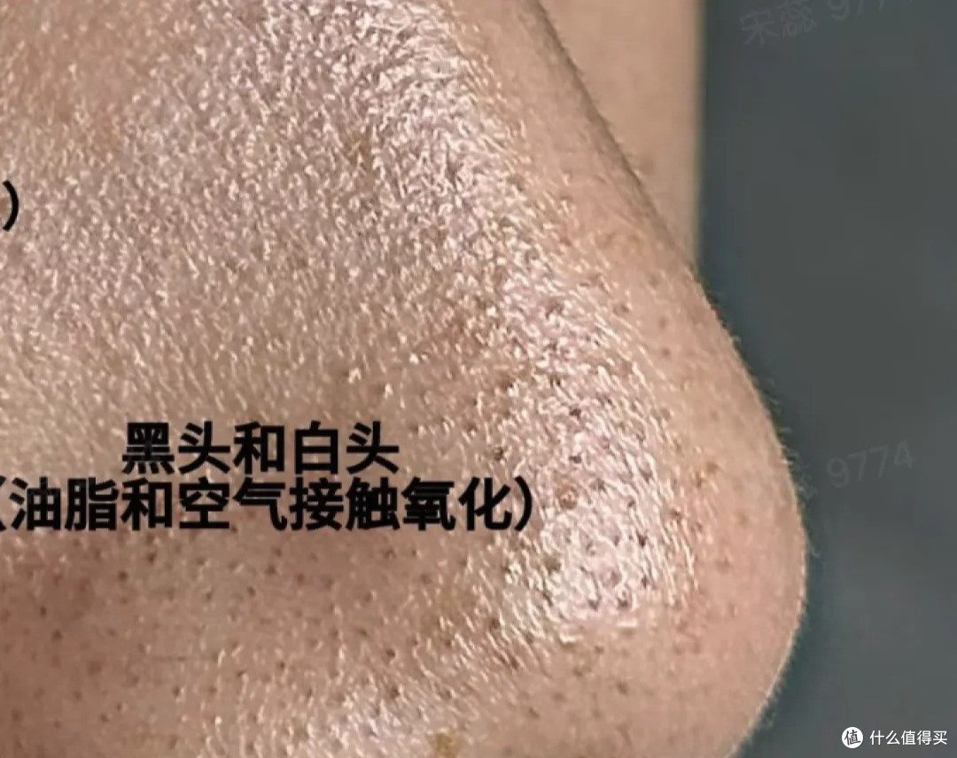 试了十几种去黑头的方法,真正有效果的只有这一个