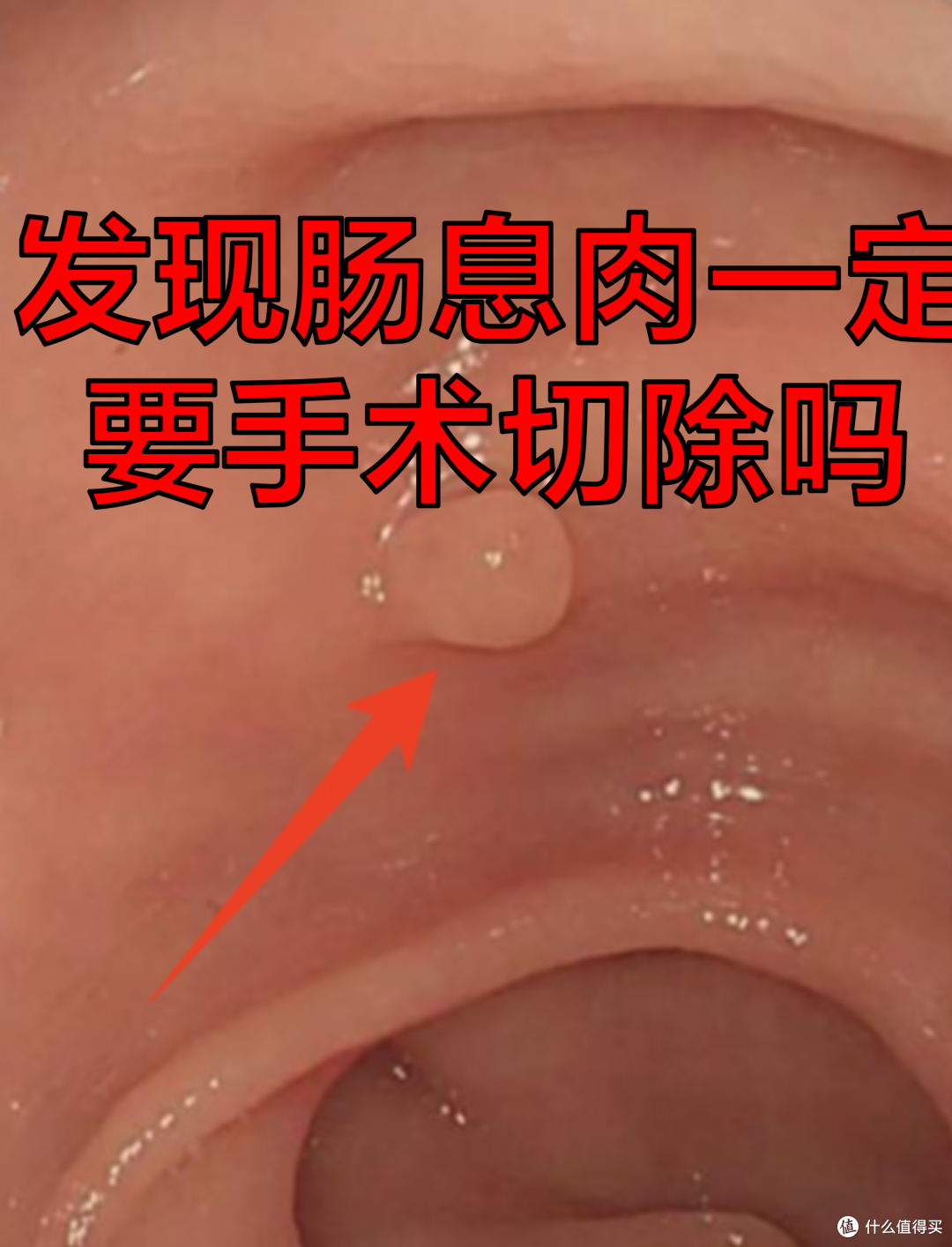 体检单上这 5 个地方长息肉,最后一个几乎 100%会癌变,要早发现