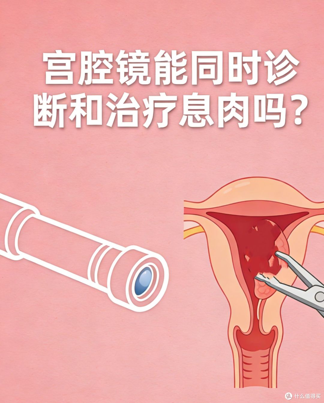 体检单上这 5 个地方长息肉,最后一个几乎 100%会癌变,要早发现