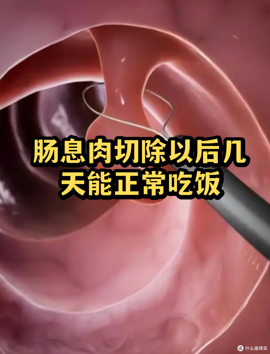 体检单上这 5 个地方长息肉,最后一个几乎 100%会癌变,要早发现