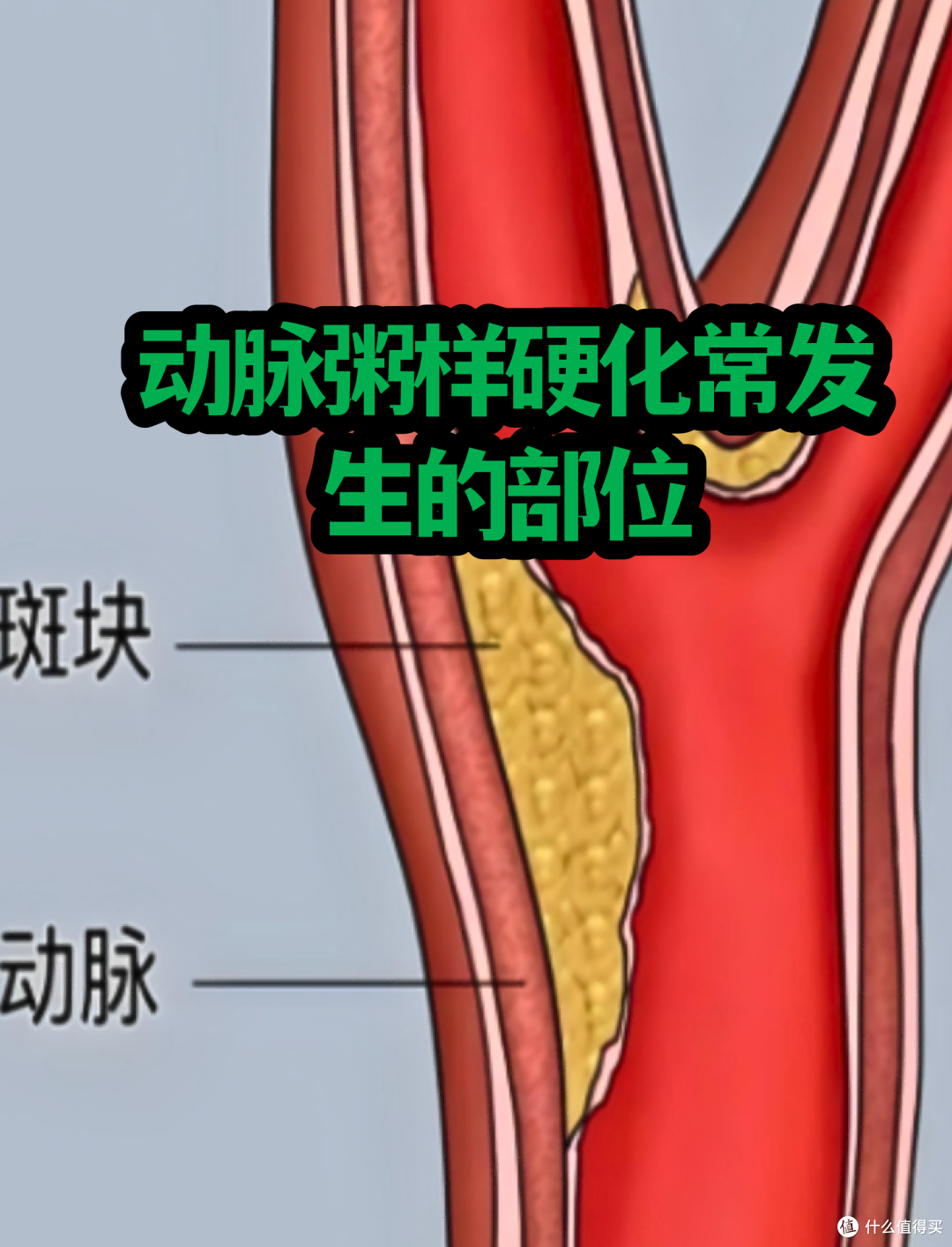 25 岁血管堵到 95%？熬夜奶茶外卖喂大的斑块，正在拖垮年轻人！