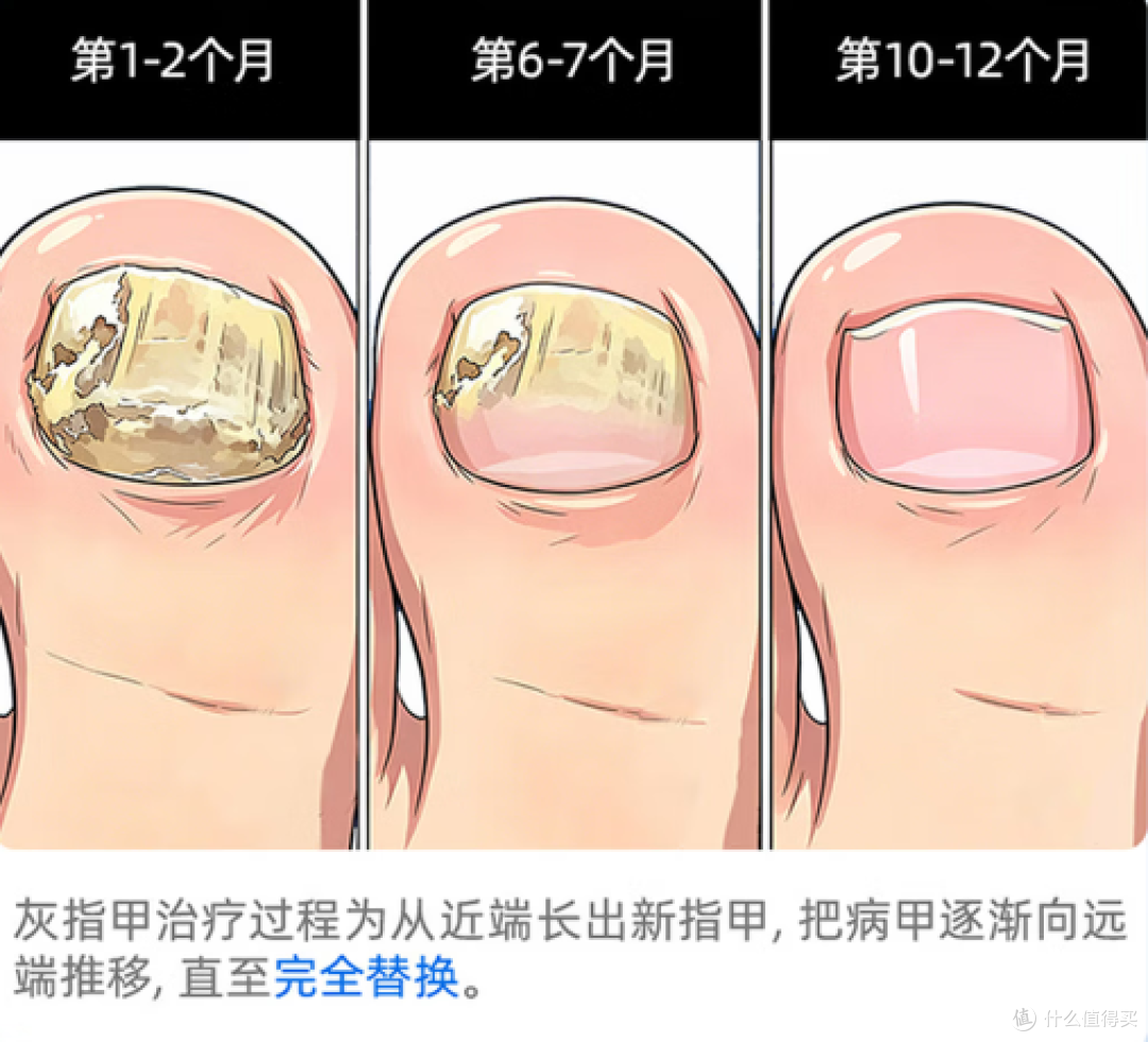 被灰指甲折腾多年,真正该买的不是“神药”