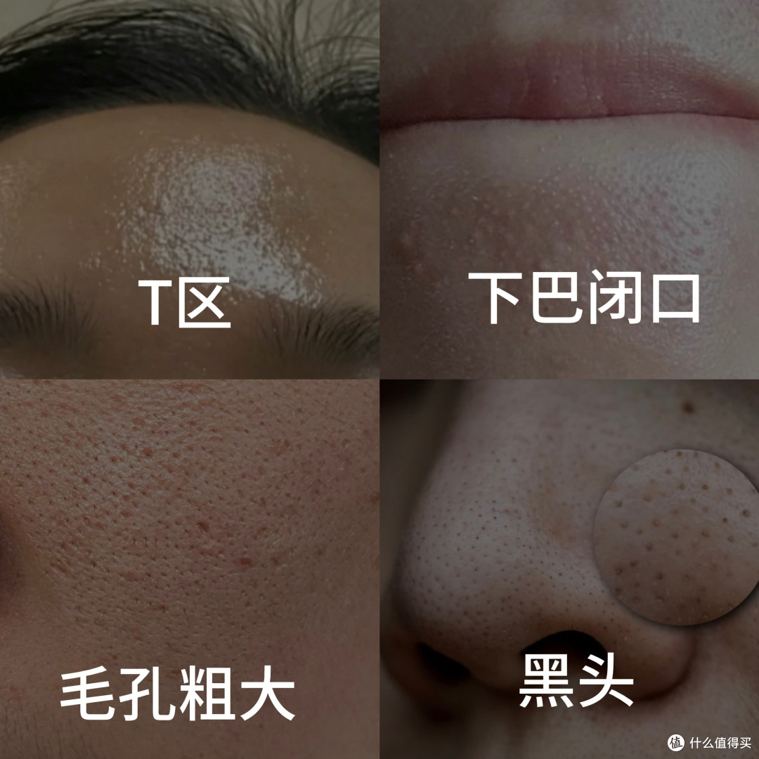 油皮"全家桶":塌头、油脸、背痘,一个都跑不掉!