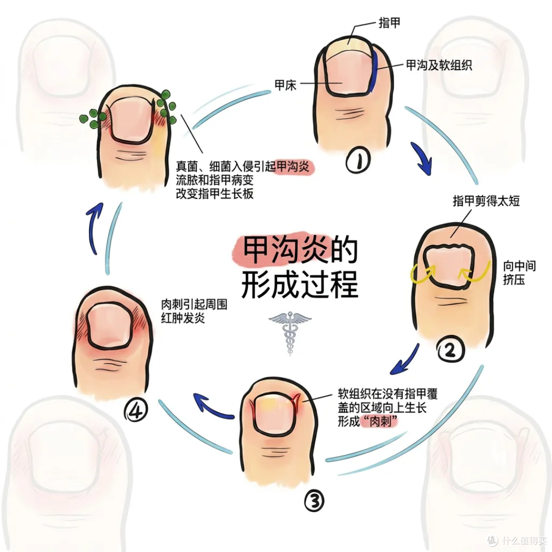 甲沟炎反复发作?千万不要剪太短!