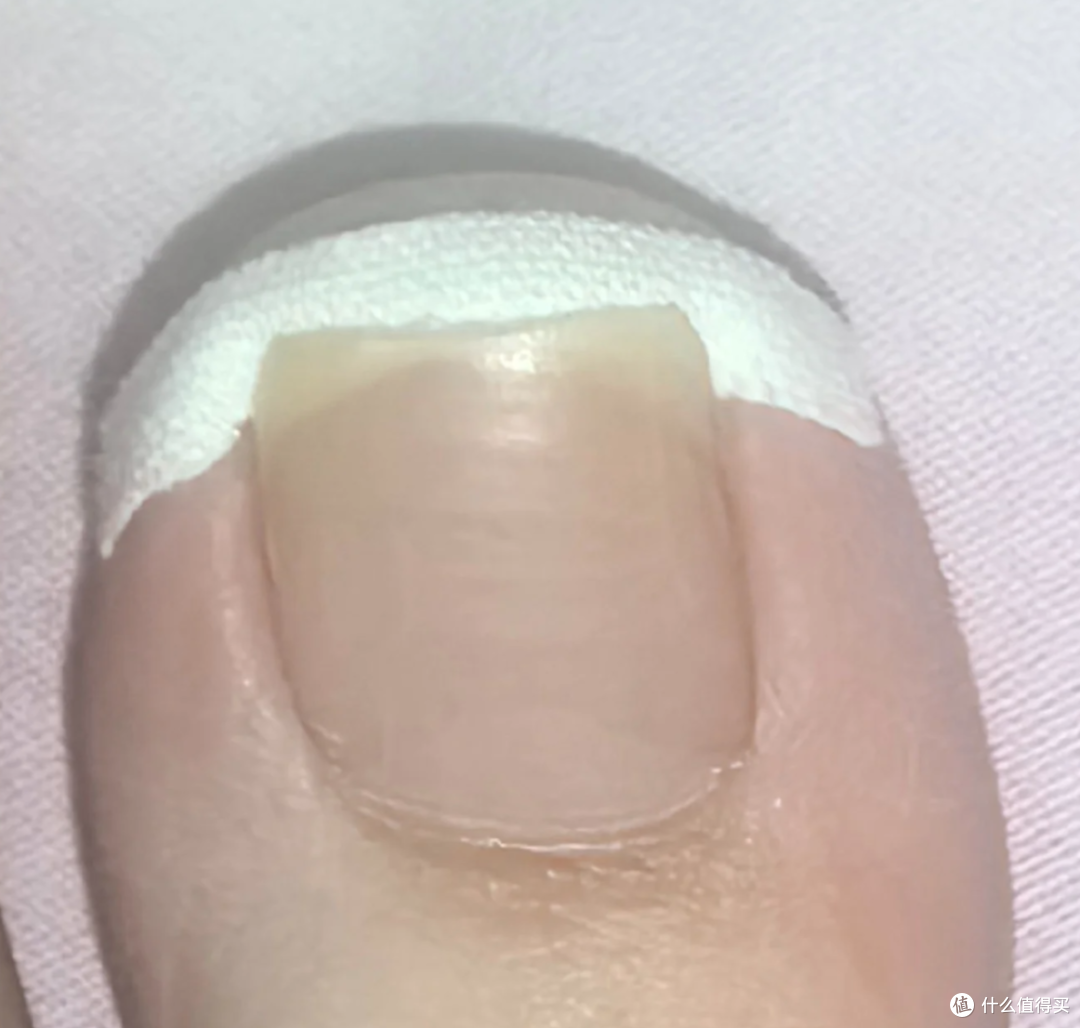 甲沟炎反复发作?千万不要剪太短!
