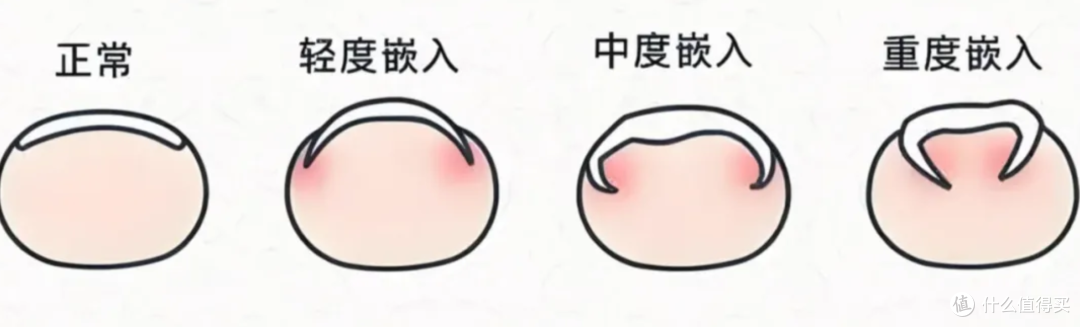 甲沟炎反复发作?千万不要剪太短!