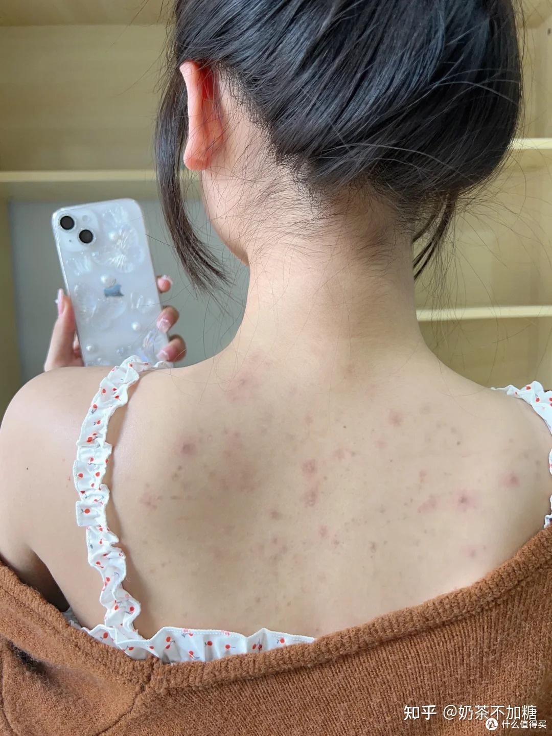 女生前胸后背长痘用什么沐浴露？4款热门沐浴露实测