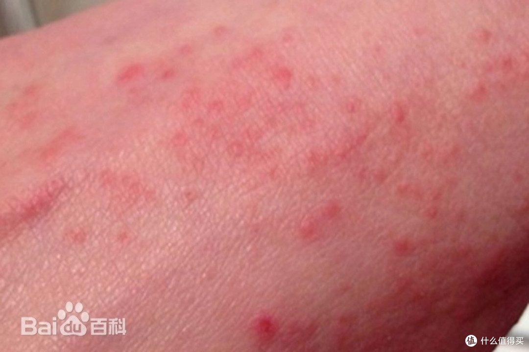 流行性斑疹伤寒