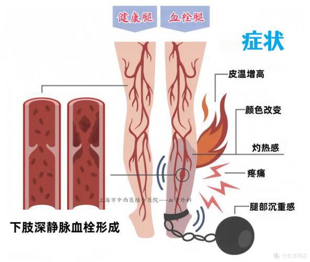 男子天天躺着玩手机确诊血栓!这个“防栓动作”很多人还不知道