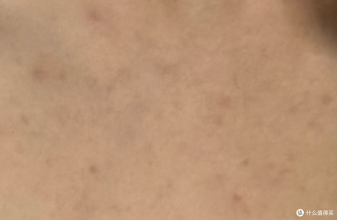后背痒个不停还越长越多?可能压根不是痘