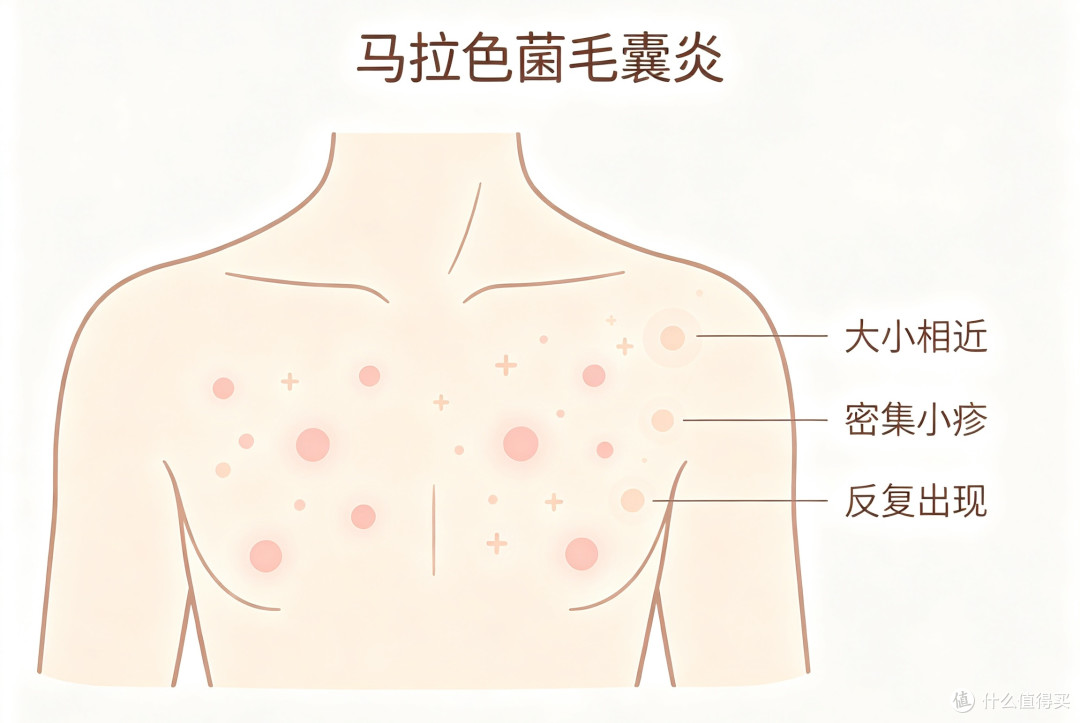 后背痒个不停还越长越多?可能压根不是痘