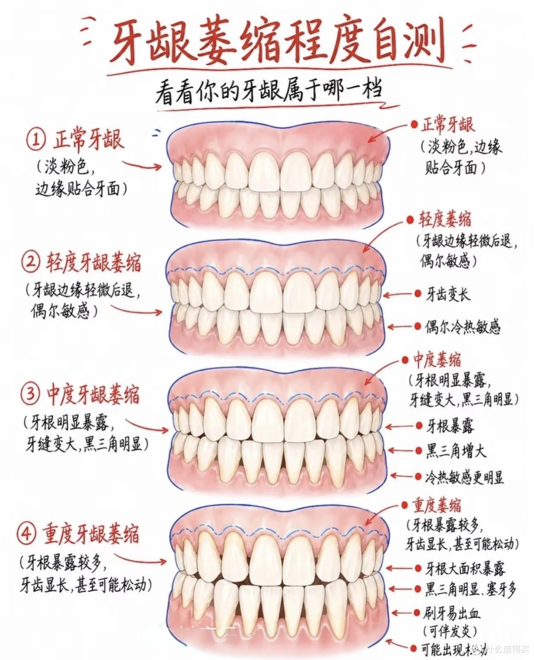 黄宗泽颜值断崖式衰老，元凶竟是牙龈萎缩