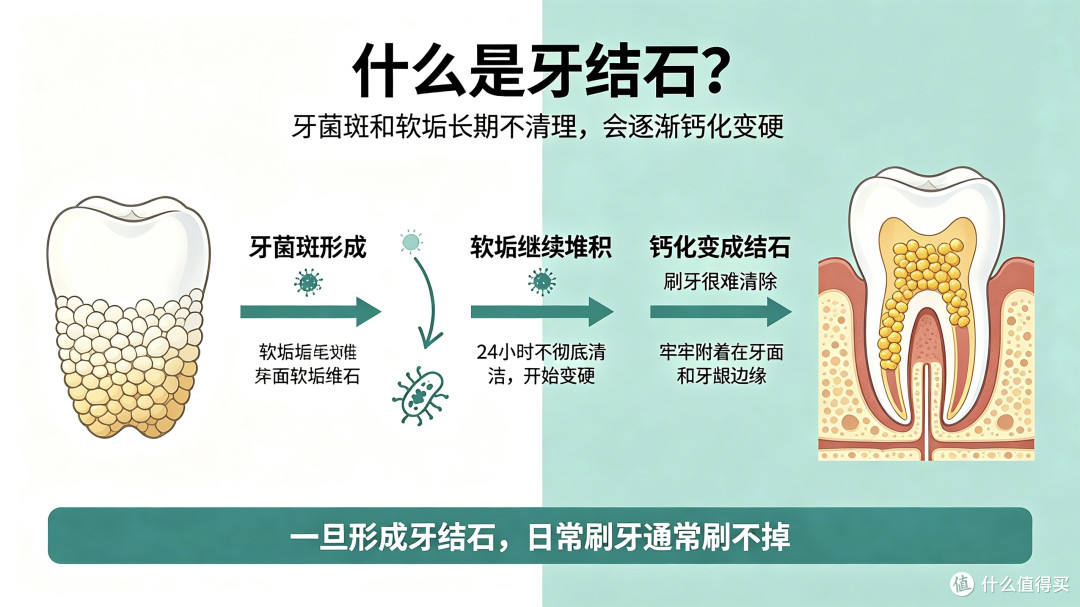 牙结石,正在悄悄毁掉你的一口牙