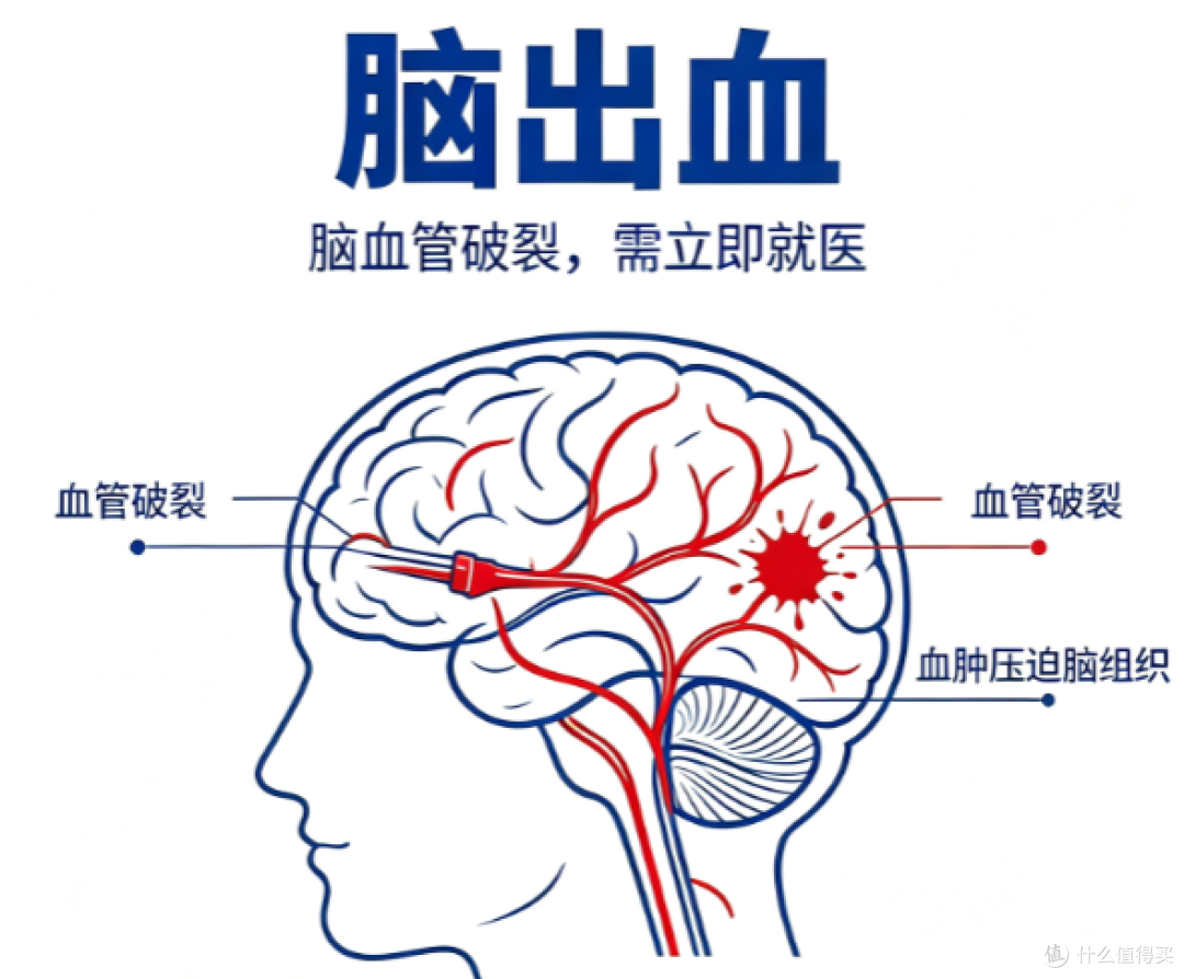 脑出血急救,最怕的不是没做,而是做错!这5件事千万别碰!