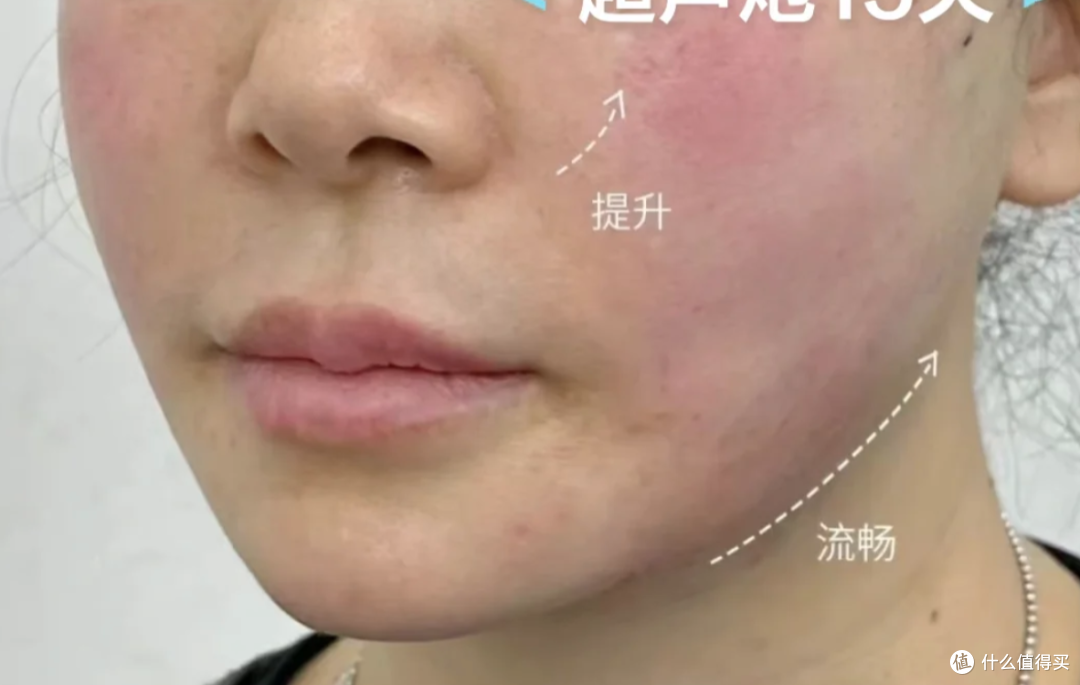 3000一针的"尸皮针",把死者皮肤打进活人脸上?抗衰真不是这么玩的