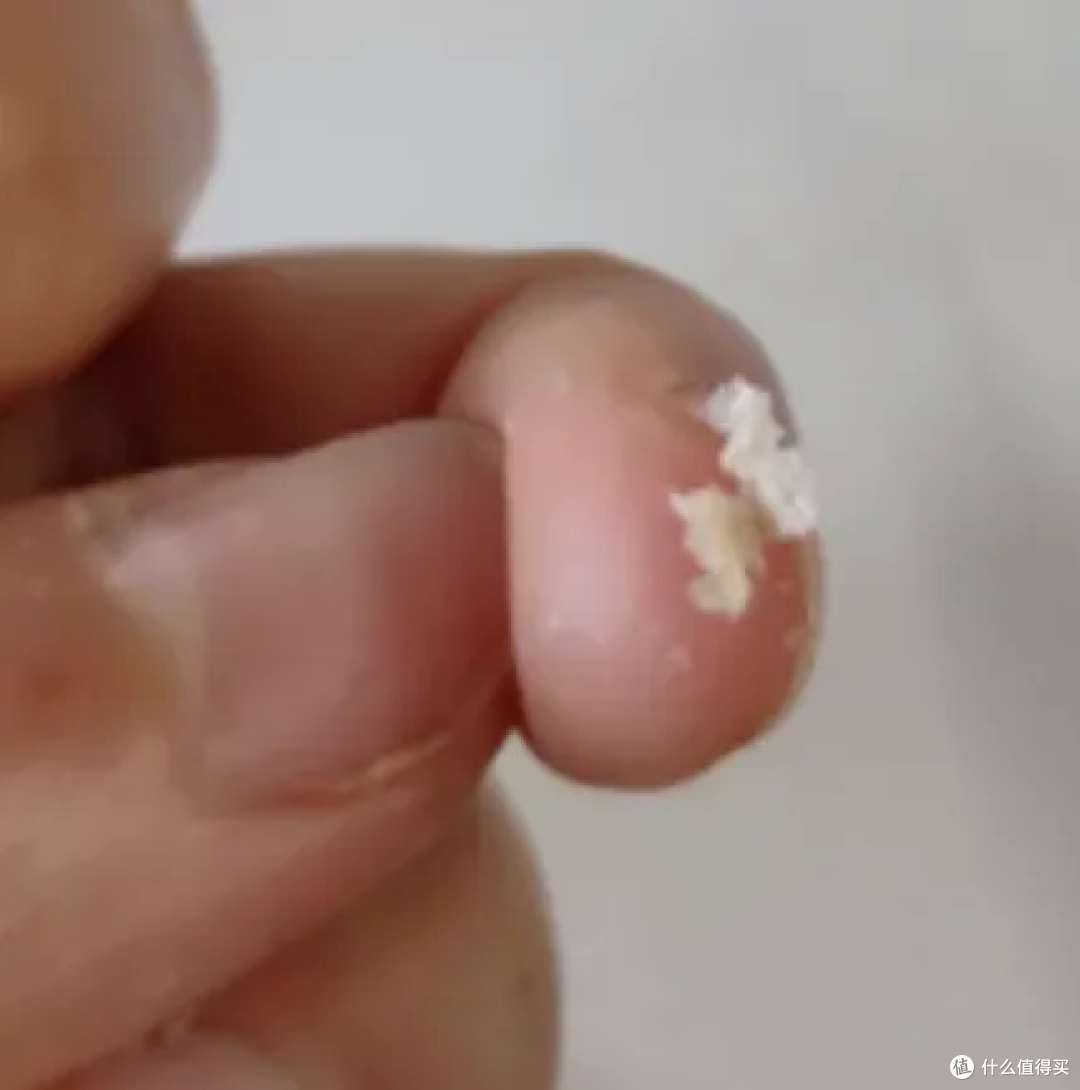 头皮抠下来的小颗粒到底是啥?扣头皮虽然爽,但可能把头抠秃