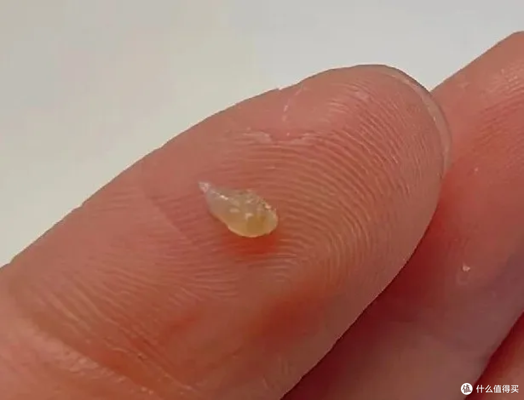 头皮抠下来的小颗粒到底是啥?扣头皮虽然爽,但可能把头抠秃