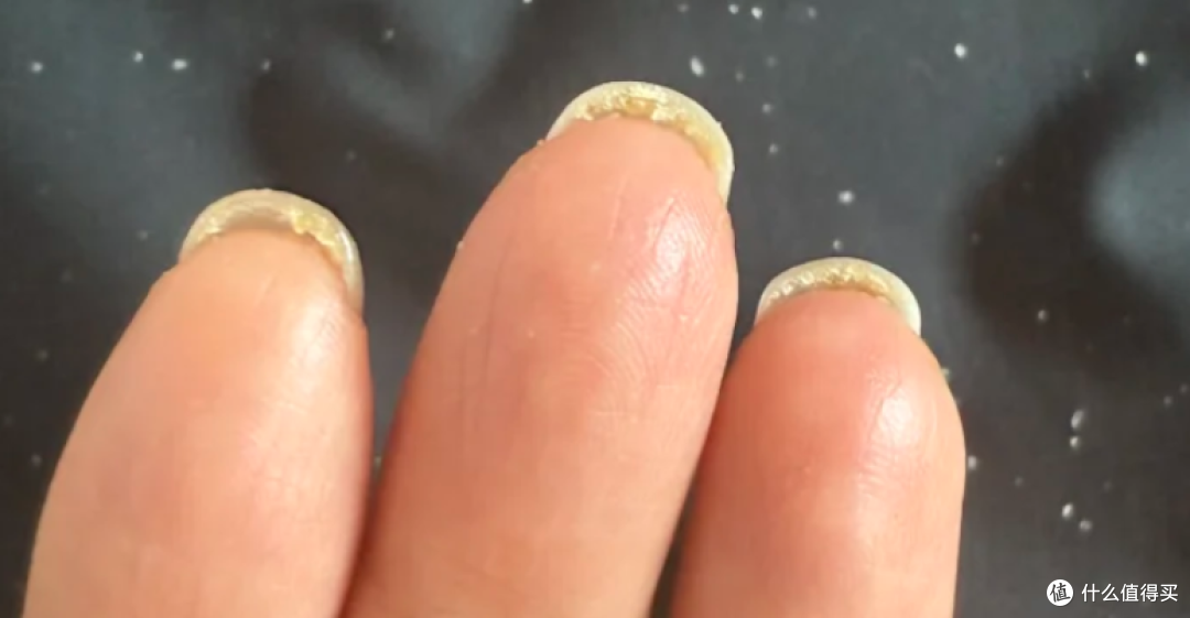 头皮抠下来的小颗粒到底是啥?扣头皮虽然爽,但可能把头抠秃