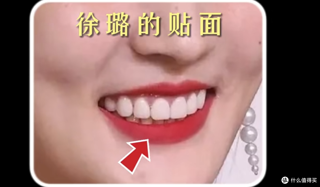 明星都在做的牙贴面，到底是个啥？值得做吗