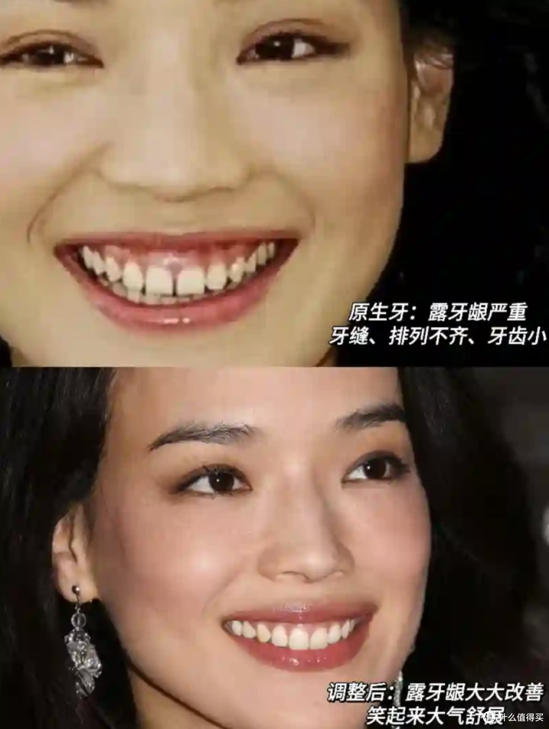 明星都在做的牙贴面，到底是个啥？值得做吗