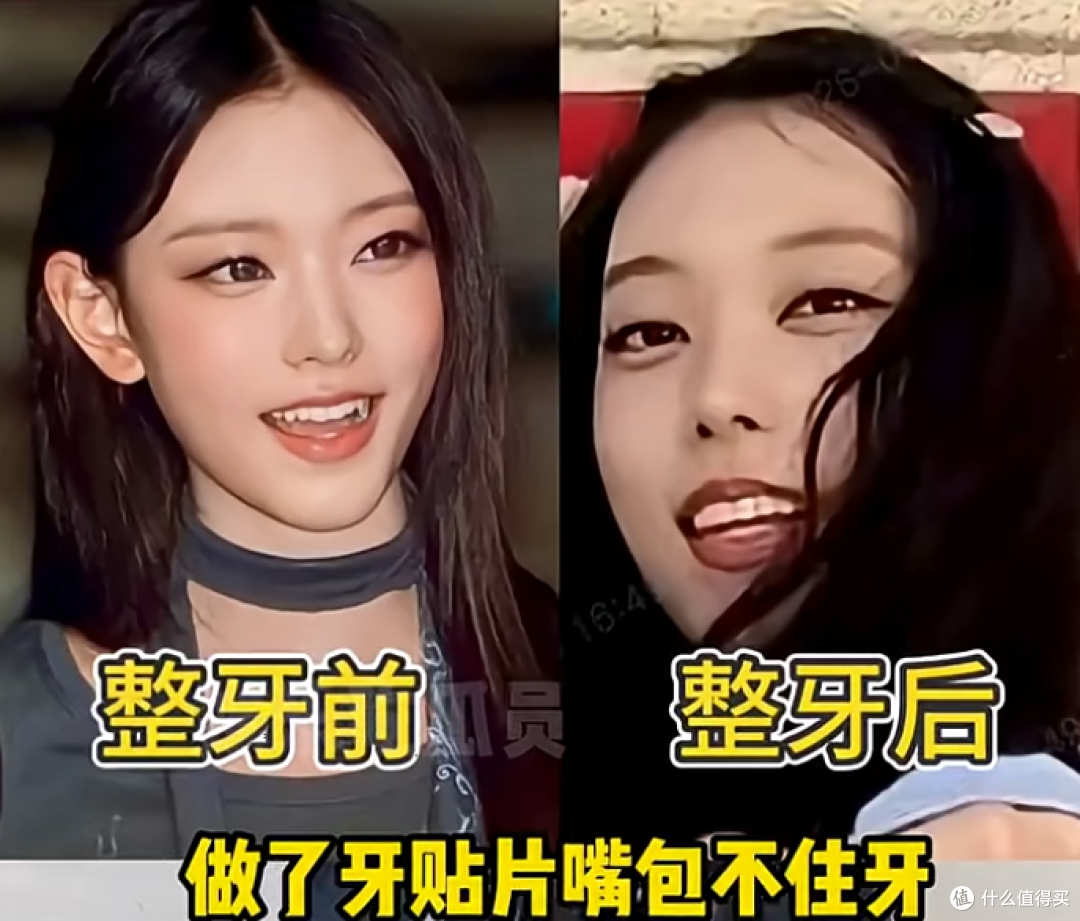 明星都在做的牙贴面，到底是个啥？值得做吗