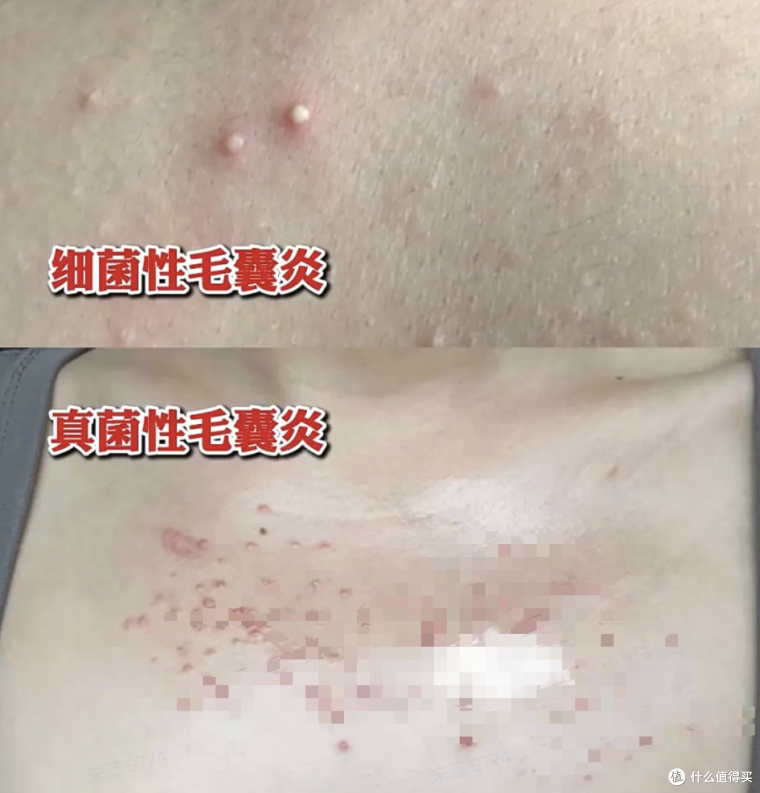后背痘越长越多,还痒个不停?很可能是它在作祟