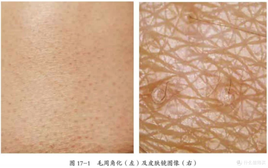 鸡皮怎么破——告别无效磨砂,科学控制毛周角化