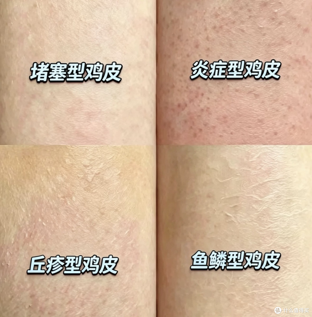 鸡皮怎么破——告别无效磨砂,科学控制毛周角化