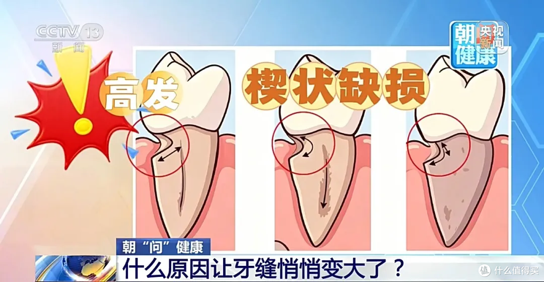 牙缝越来越大、总塞牙?不是老了,是牙周在“报警”