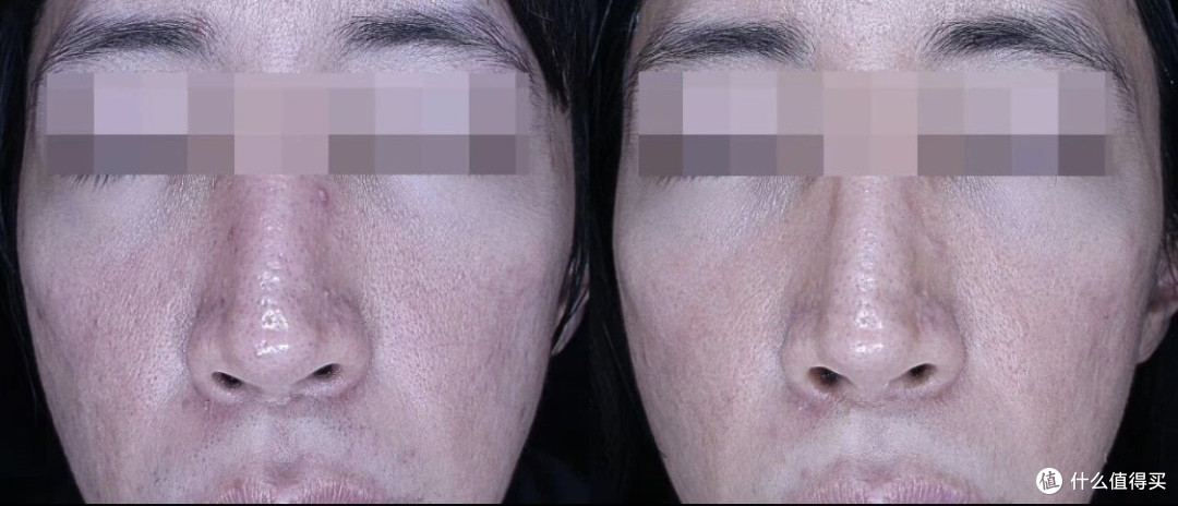 Re2O 治疗（间隔一个月，共 3 次）的患者真实对比图