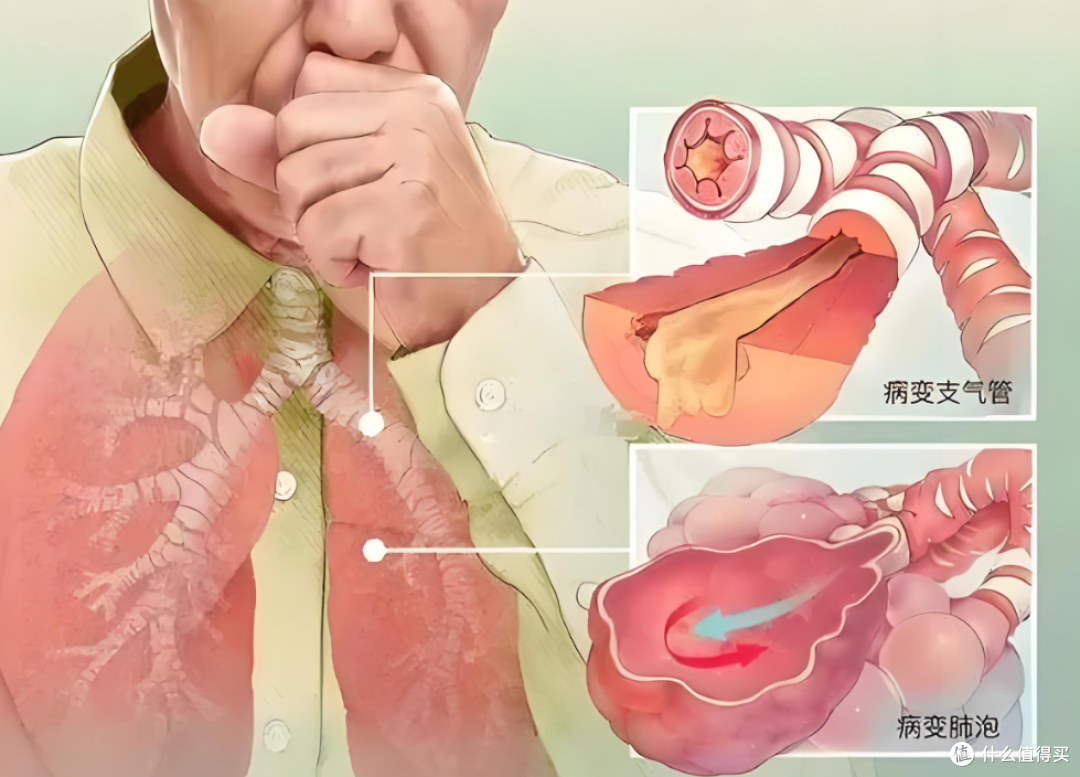 黄痰轻,黑痰重,吐了白痰更要命?不同种颜色的痰液究竟代表什么