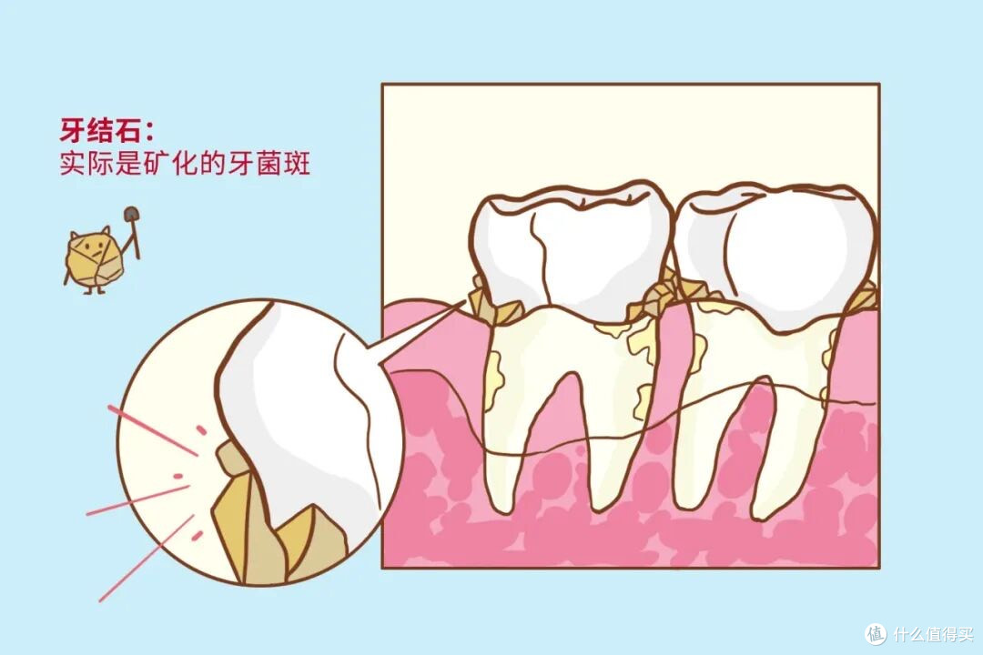 口臭不是胃的锅!牙缝里那块黄石头,才是你张嘴就社死的元凶