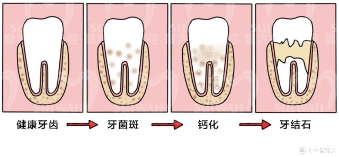 口臭不是胃的锅!牙缝里那块黄石头,才是你张嘴就社死的元凶
