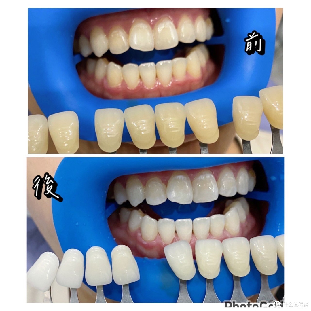 冷光美白前后对比