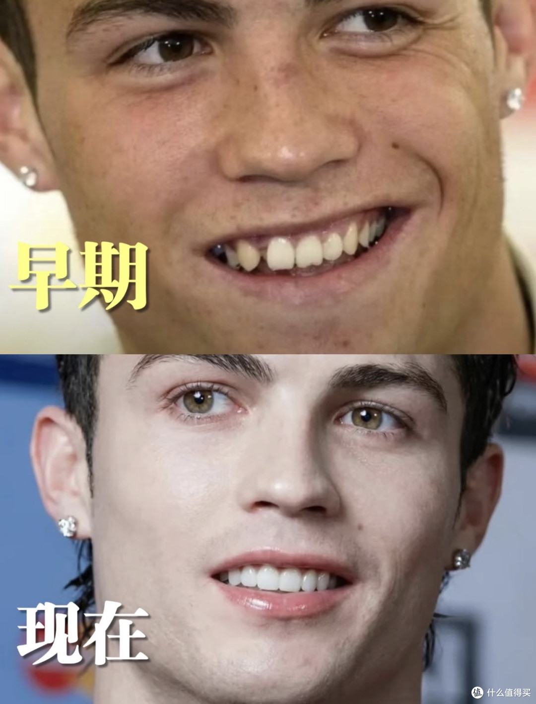 牙齿对颜值的重要性:那个不敢大笑的龅牙男,花20年把牙修成王者
