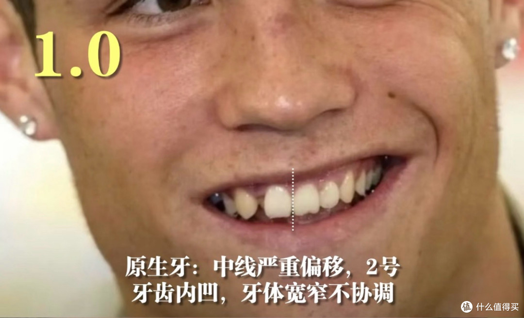 牙齿对颜值的重要性:那个不敢大笑的龅牙男,花20年把牙修成王者