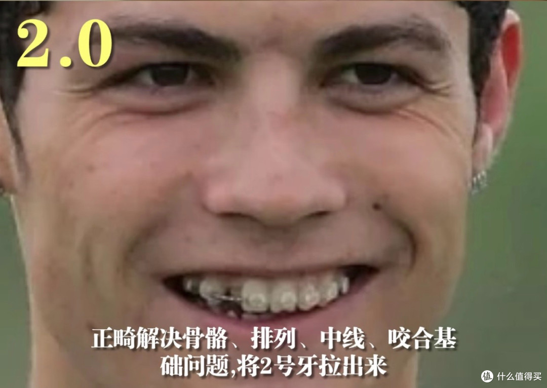 牙齿对颜值的重要性:那个不敢大笑的龅牙男,花20年把牙修成王者