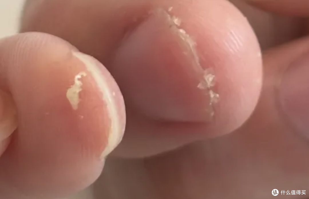 为什么耳廓一圈总是油腻腻的,有时候还会有皮屑?