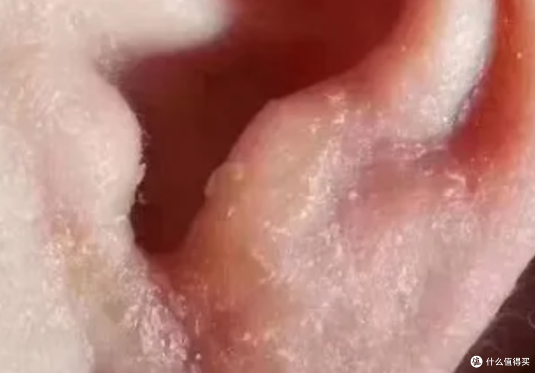 为什么耳廓一圈总是油腻腻的,有时候还会有皮屑?