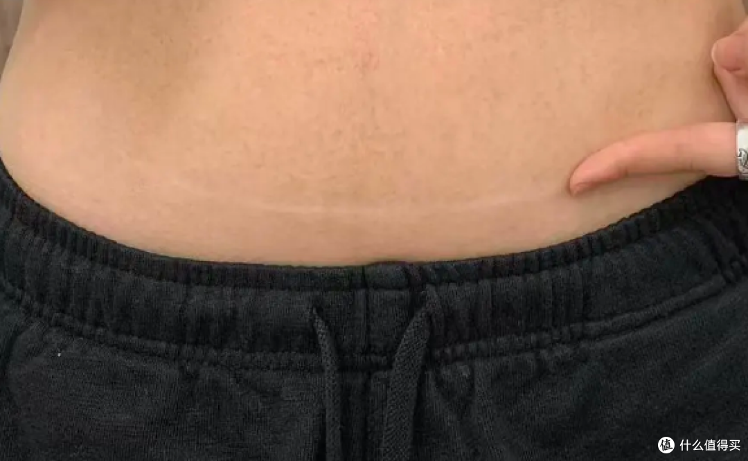 剖腹产疤痕用什么疤痕贴,宝妈真实分享,四款硅酮疤痕贴横评