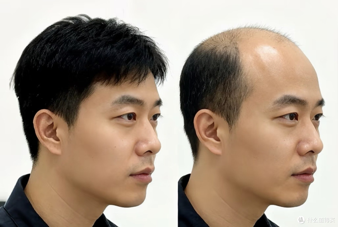 同头不同命：后脑勺这圈头发，还够不够植一次？